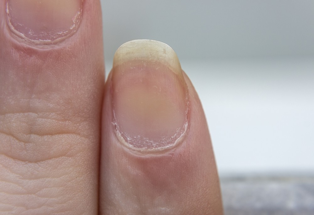 My City - What causes yellow nails and how to cure this problem