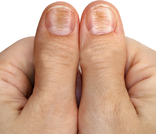 5 Signs of Underlying Disease From Your Feet